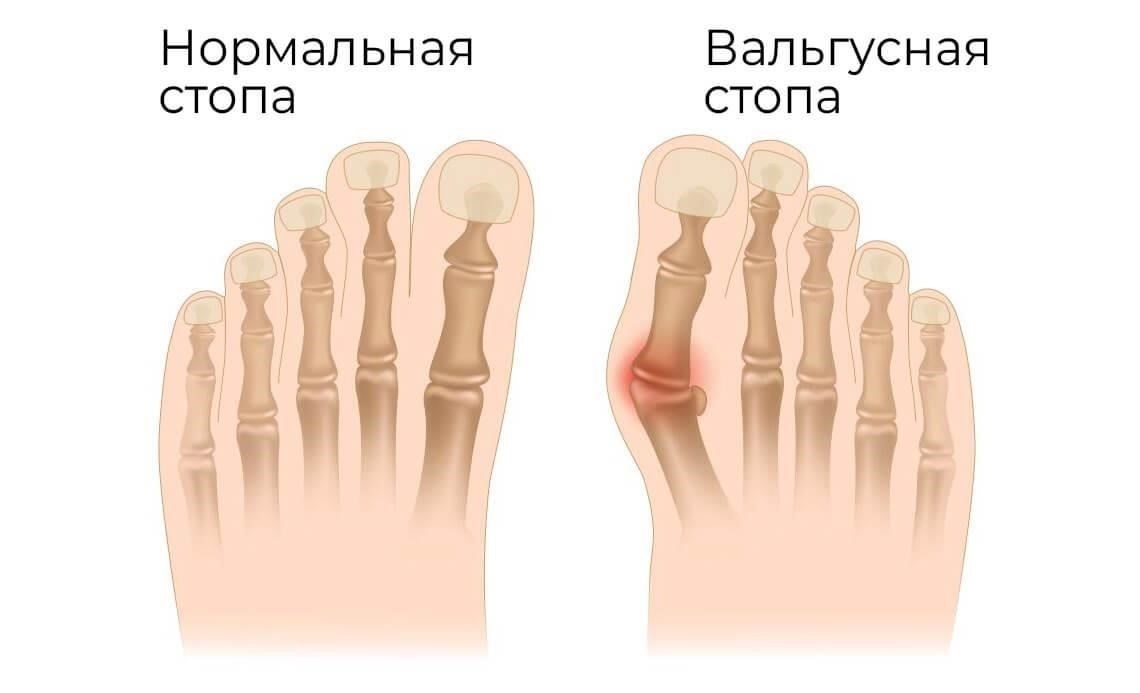 Наличие выраженного продольного плоскостопия не является автоматическим препятствием для призыва в армию. Решение зависит от степени деформации, ее влияния на общую функцию стопы, а также от того, вызывает ли она значительные проблемы при физических нагрузках или ношении военной обуви. Те, у кого симптомы минимальны или отсутствуют, несмотря на наличие плоскостопия, могут быть признаны годными к службе.