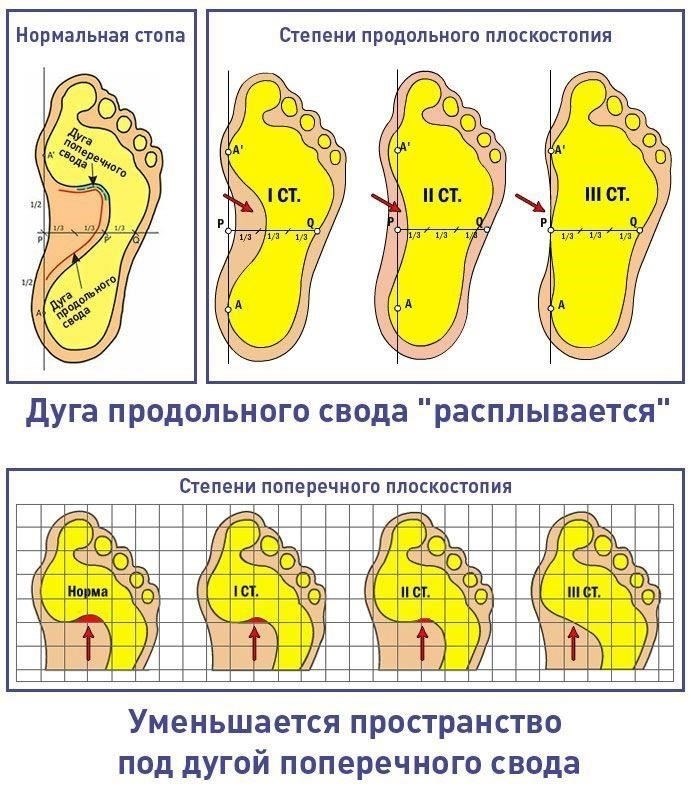 Плоскостопие и военная служба: Что нужно знатьПлоскостопие, или pes planus, может повлиять на пригодность к военной службе в зависимости от степени тяжести. Состояние оценивается по степени разрушения свода стопы и по тому, вызывает ли оно боль или ухудшает подвижность. Человек с легкой формой плоскостопия может служить, если это состояние не вызывает значительного дискомфорта или функциональных ограничений. Однако более тяжелые формы плоскостопия, особенно если они сопровождаются болью в своде стопы, пятке или плюсневой области, могут лишить человека права служить в армии. Это особенно верно, если возникают посттравматические осложнения или состояние связано с деформацией суставов или костей.