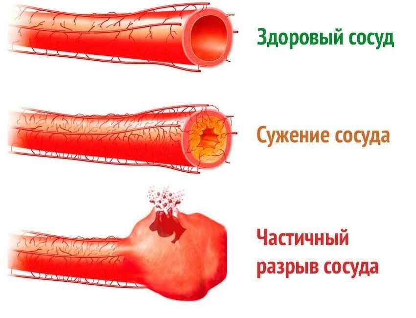Понимание сути геморроя: Острые и хронические формы
