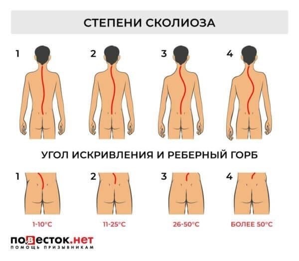 Пригодность к военной службе лиц со сколиозом 1-й и 2-й степени