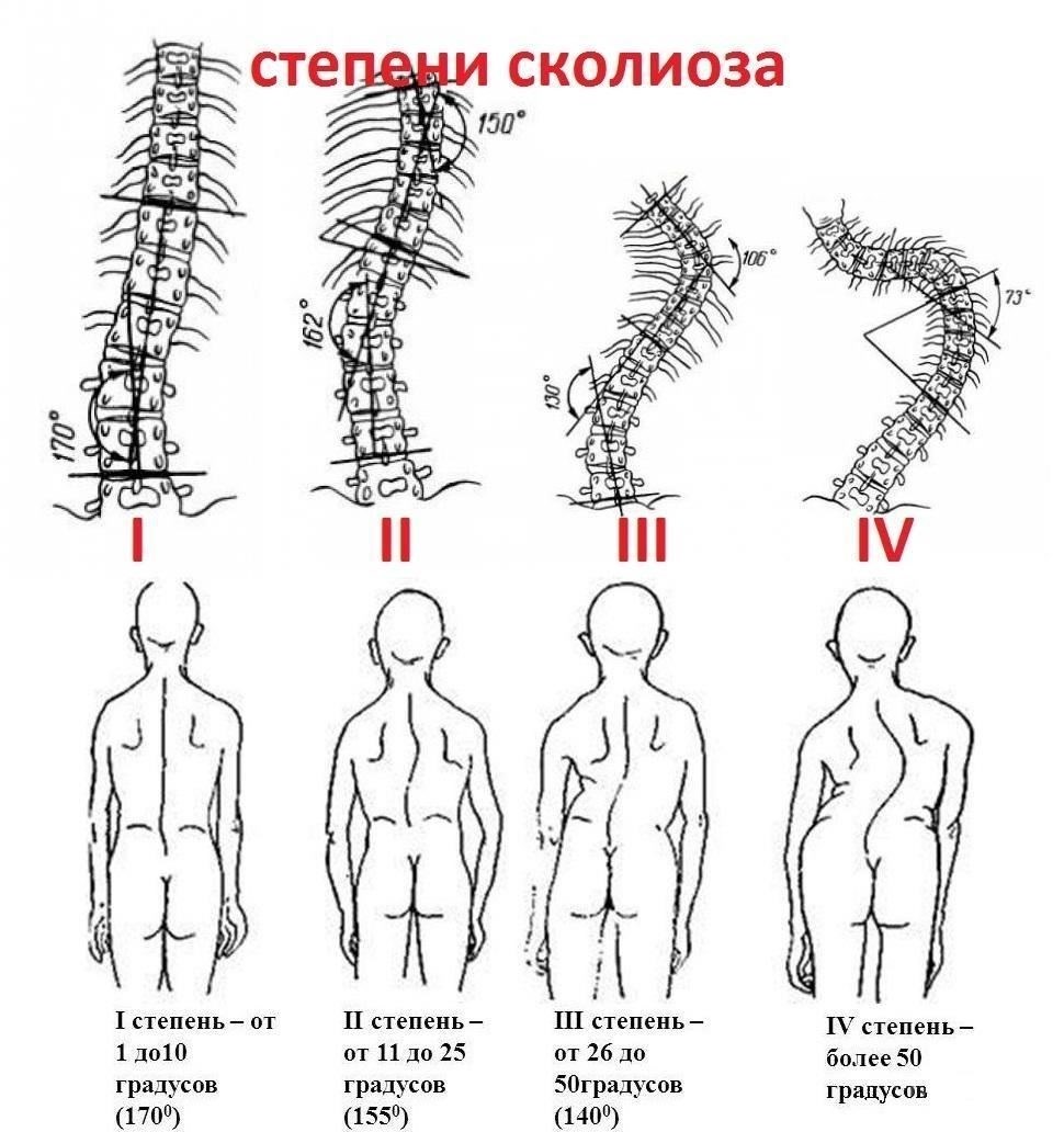 Влияние сколиоза 2-й степени на военную службу